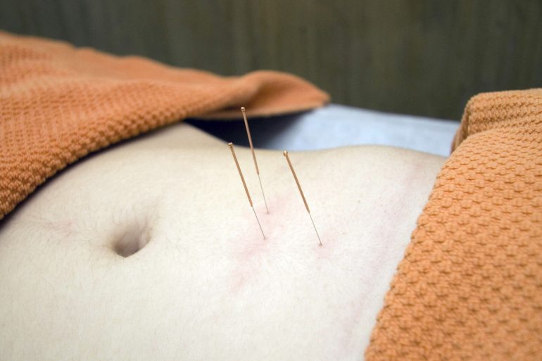 Acupuncture For Weight Loss - does it really work?